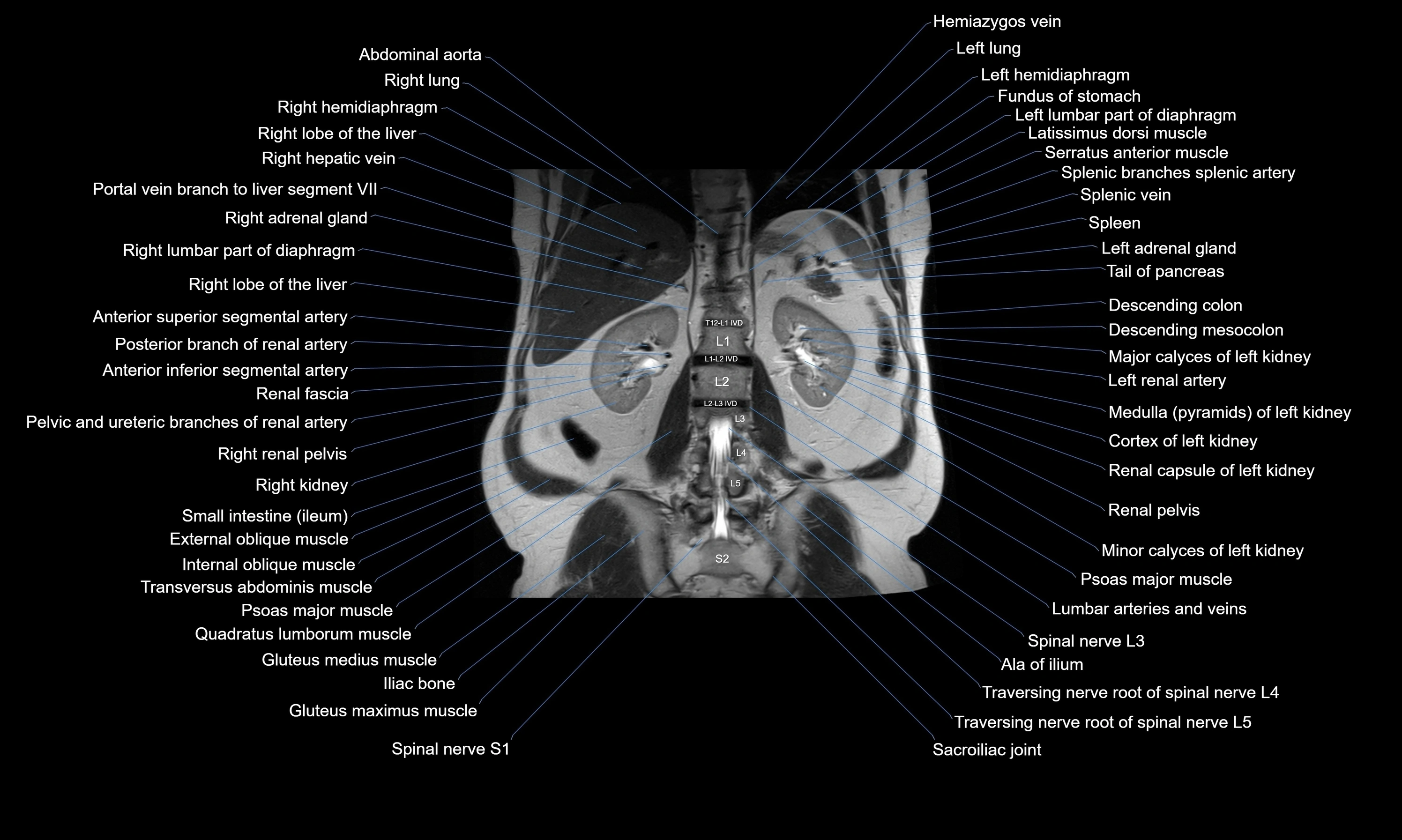 MRI Abdomen axial cross sectional anatomy radiology  image-img-00001-00040.webp